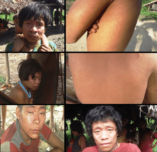 WATANIBA: El pueblo Yanomami amenazado por brote de sarampión